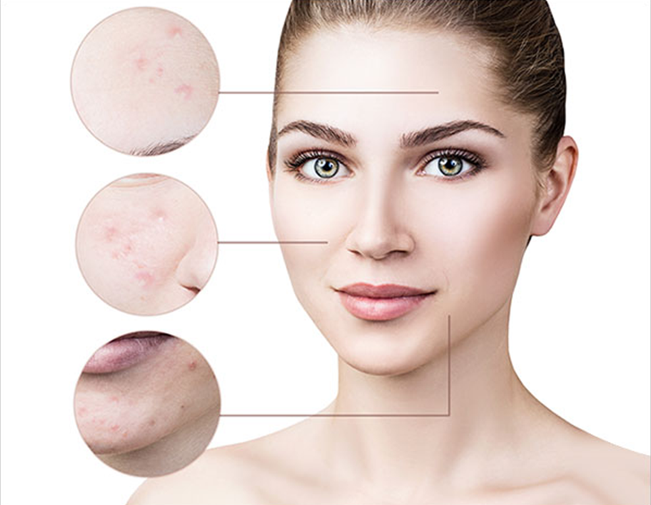 Acne Scars